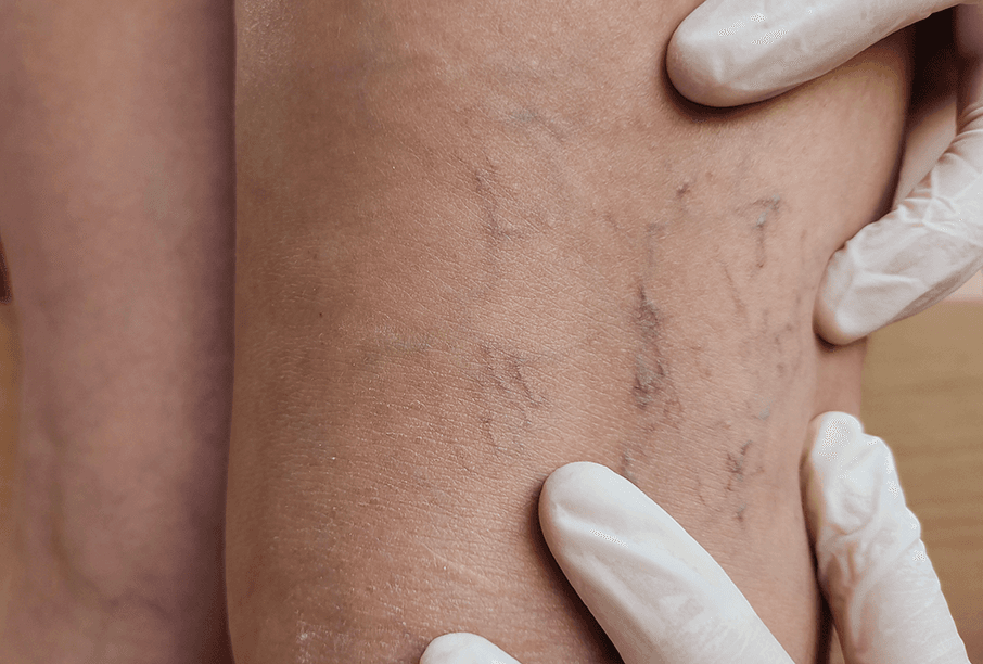 Physician examining spider veins on a patient’s leg