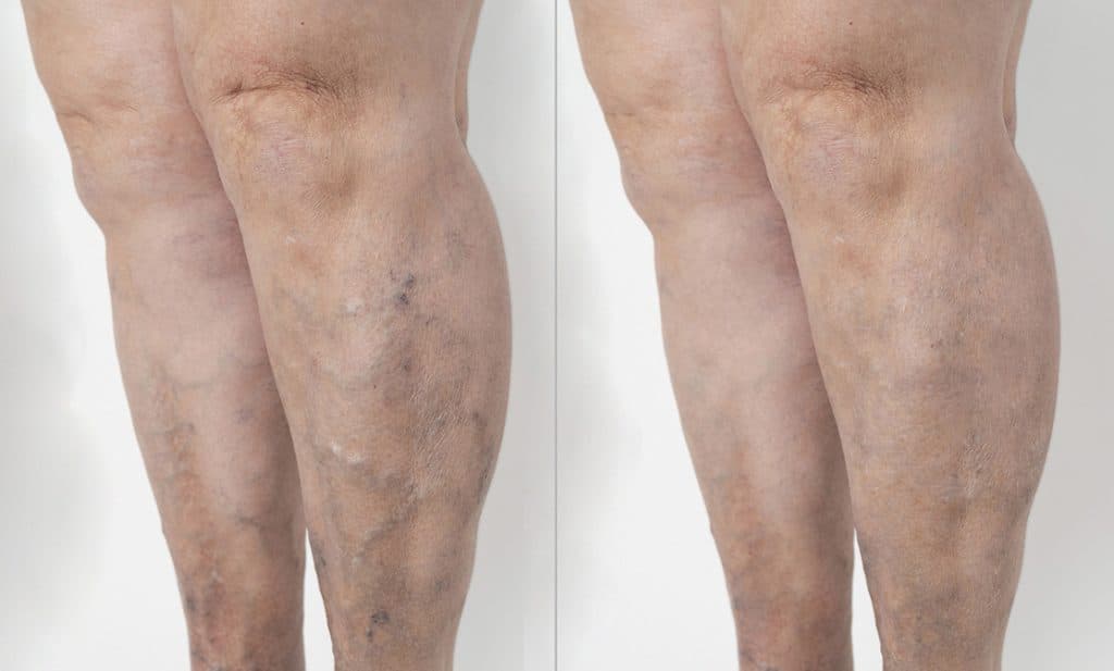 Visible leg veins before and after vein treatment